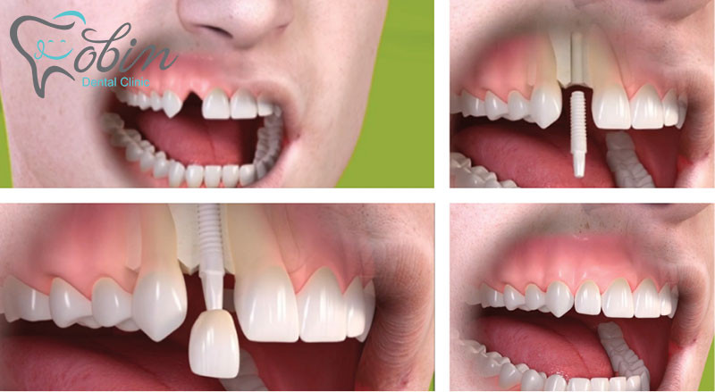 انواع ایمپلنت دندان های جلو